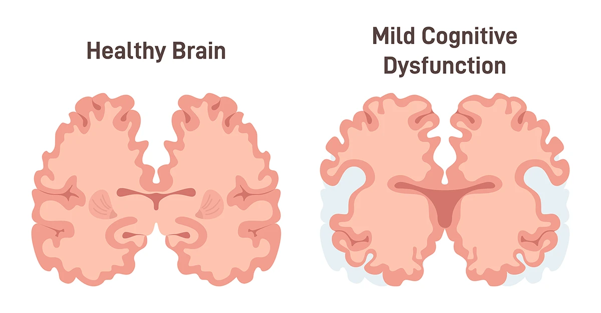 Healthy brain vs. mild cognitive impairment illustration
