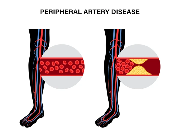 Peripheral artery disease