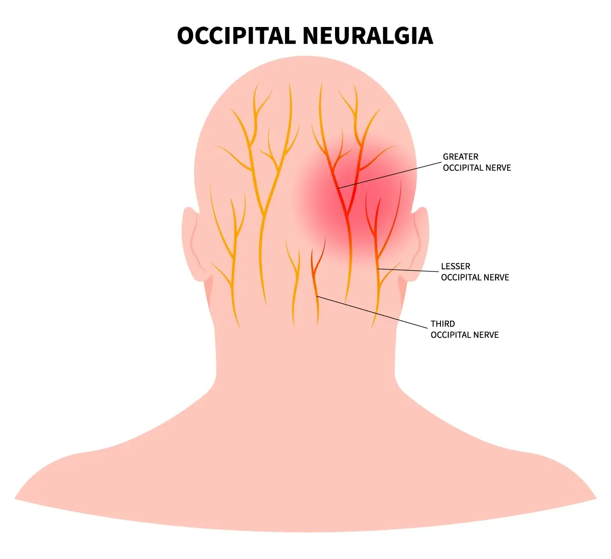 Occipital Neuralgia