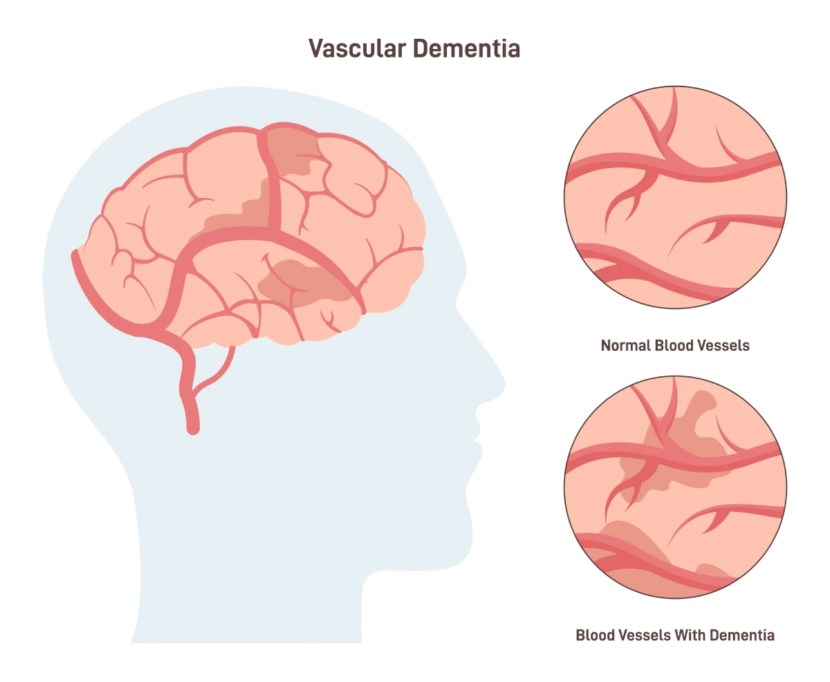 Image shows the difference between normal blood vessels in your brain and blood vessels disrupted by vascular dementia, a common type of dementia. Vascular dementia causes microscopic bleeding in the brain.
