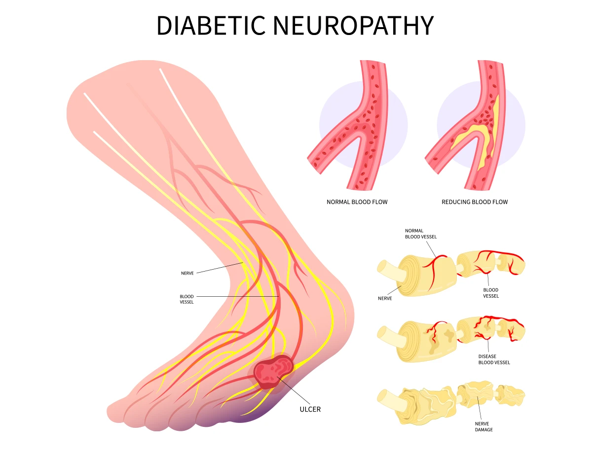 Diabetic neuropathy can cause ulcers, disrupt blood flow and damage nerves on your foot.