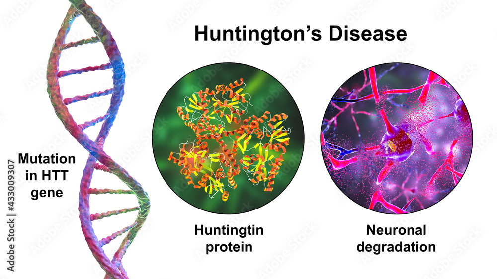 A representation of the mutation that causes Huntington’s disease, the abnormal proteins created because of the mutation and the eventual damage to nerves in the brain.