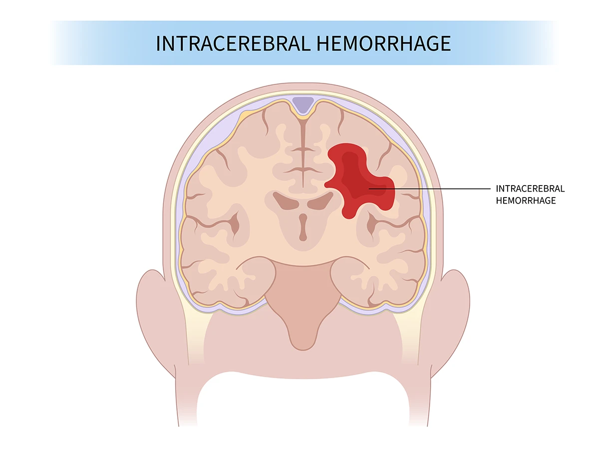 intracerebral