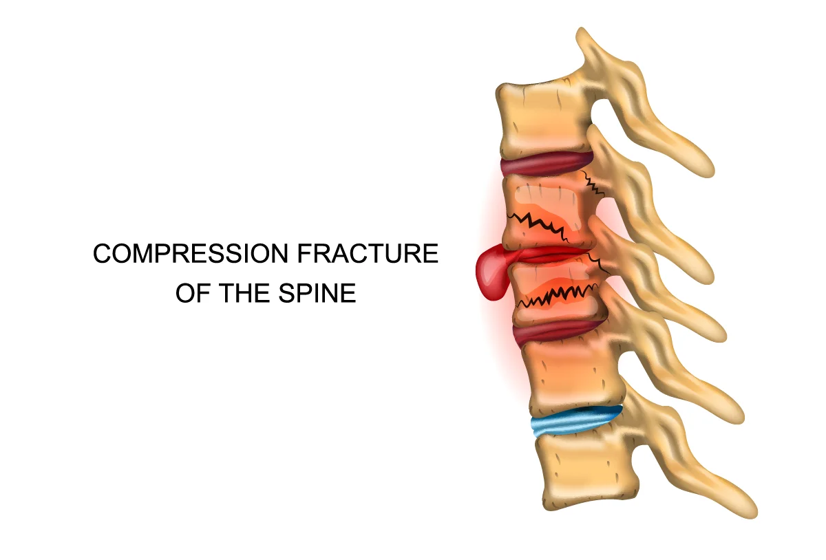 Spinal compression fracture