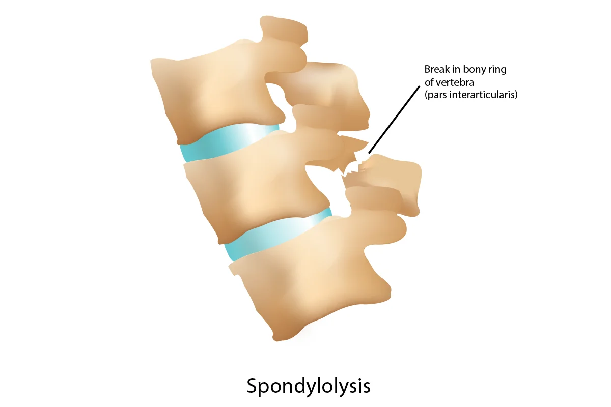 Side view of the spine shows the pars interarticularis – the part of the vertebra that’s fractured in spondylolysis