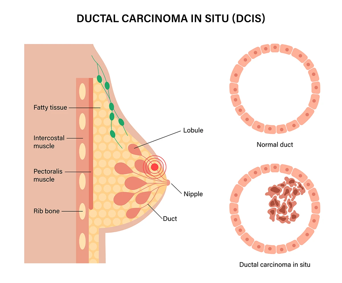 The image shows the anatomy of the breast and gives a comparison of a normal milk duct and one that has ductal carcinoma in situ, or DCIS.