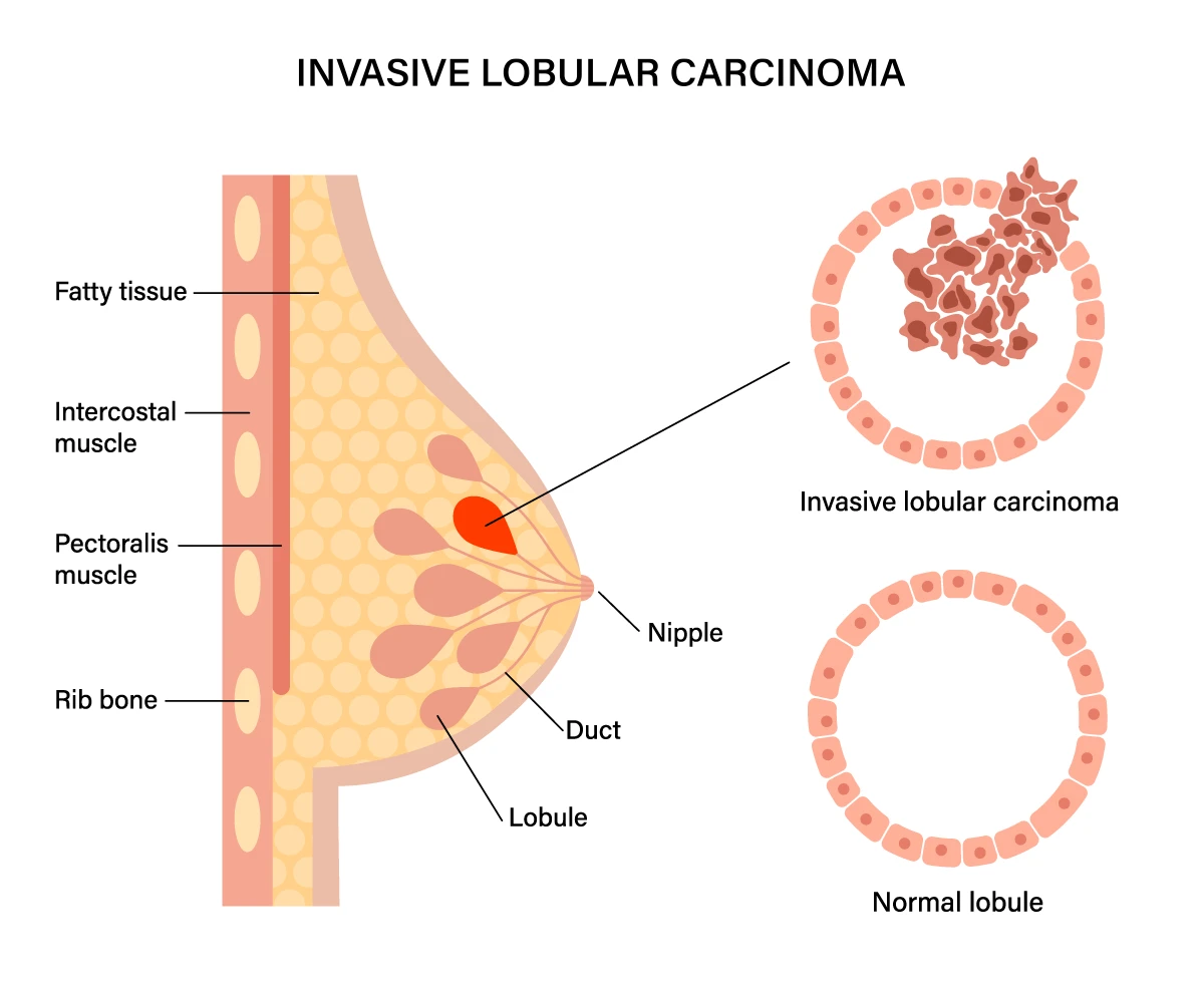 The image shows the difference between a normal milk duct in the breast tissue and one with invasive lobular carcinoma, where the cancer cells have spread outside the duct.