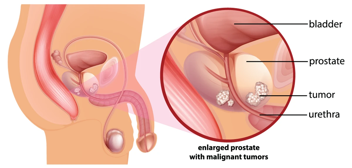 Image shows an enlarged prostate gland with malignant tumors located below the bladder and surrounding the urethra.