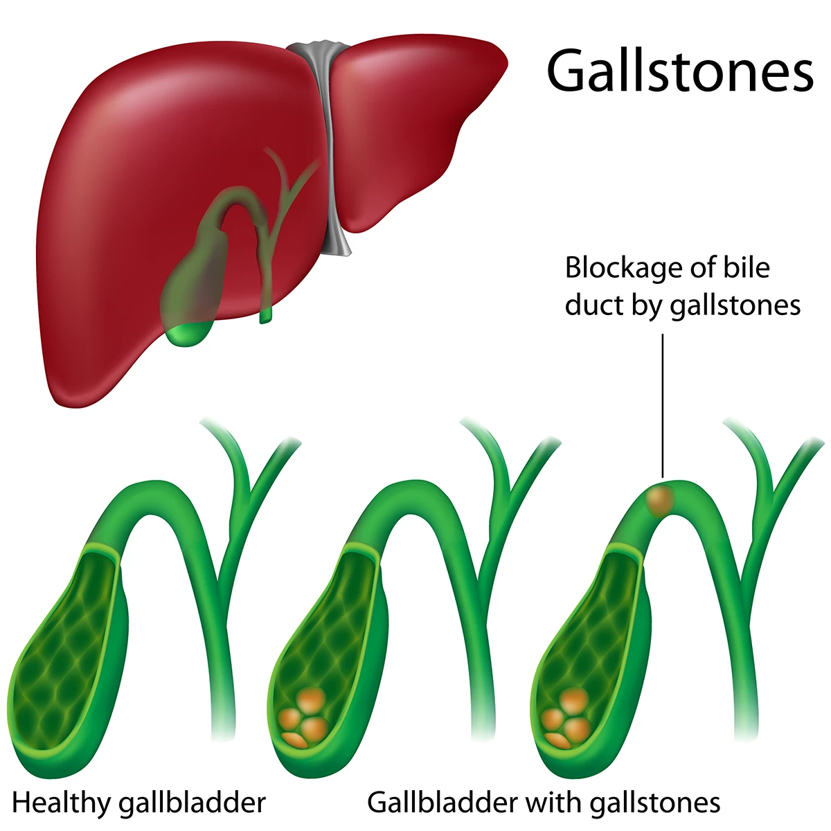 Gallstone image