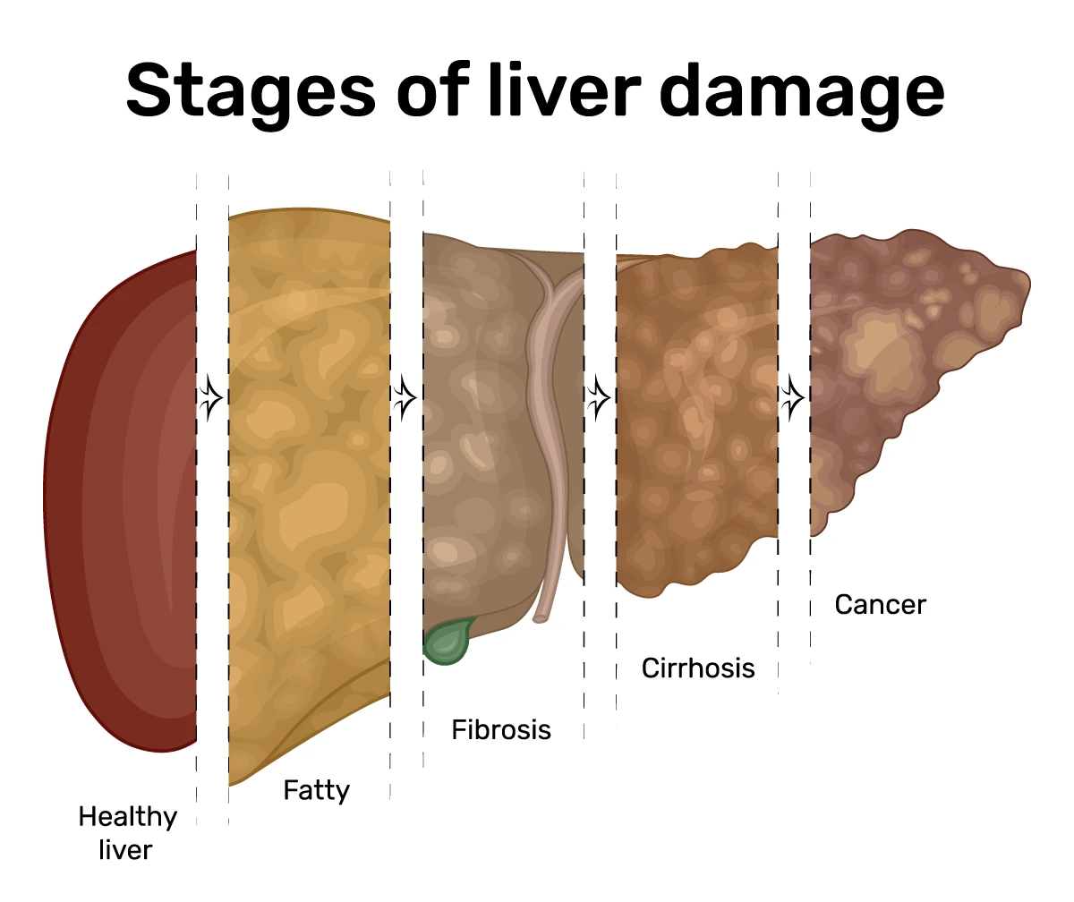 Stages of liver disease