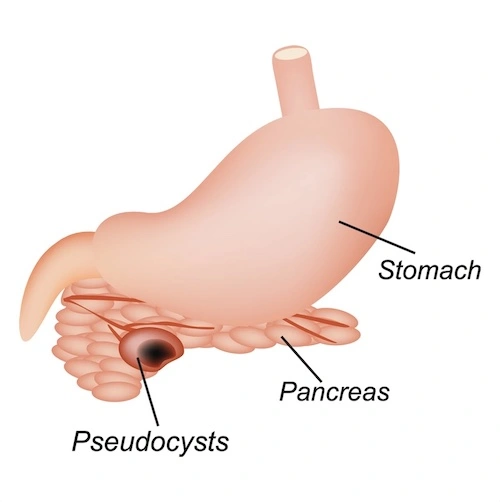 pancreatic pseudocyst