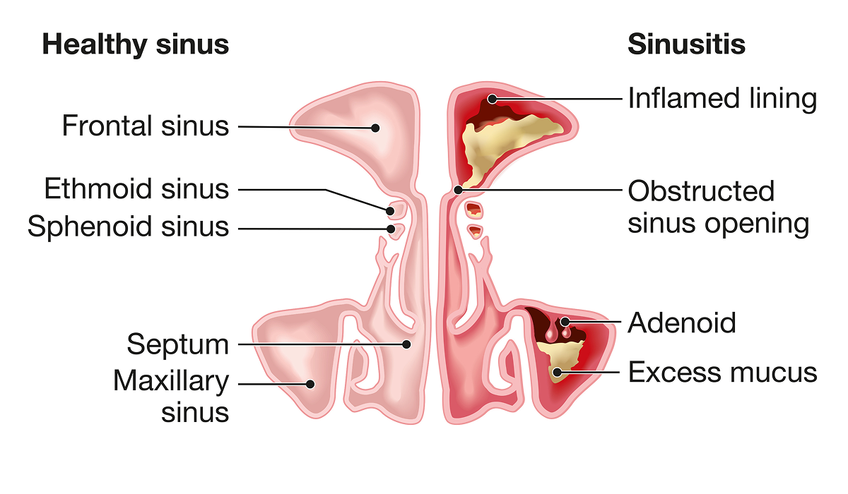 A diagram showing a side-by-side comparison of healthy sinus and sinus with sinusitis. The healthy side has open, clear sinuses, while the sinusitis side has inflamed sinus lining, obstructed sinus openings, excess mucus and swollen adenoids. Labels identify the frontal, ethmoid, sphenoid and maxillary sinuses, as well as the septum.