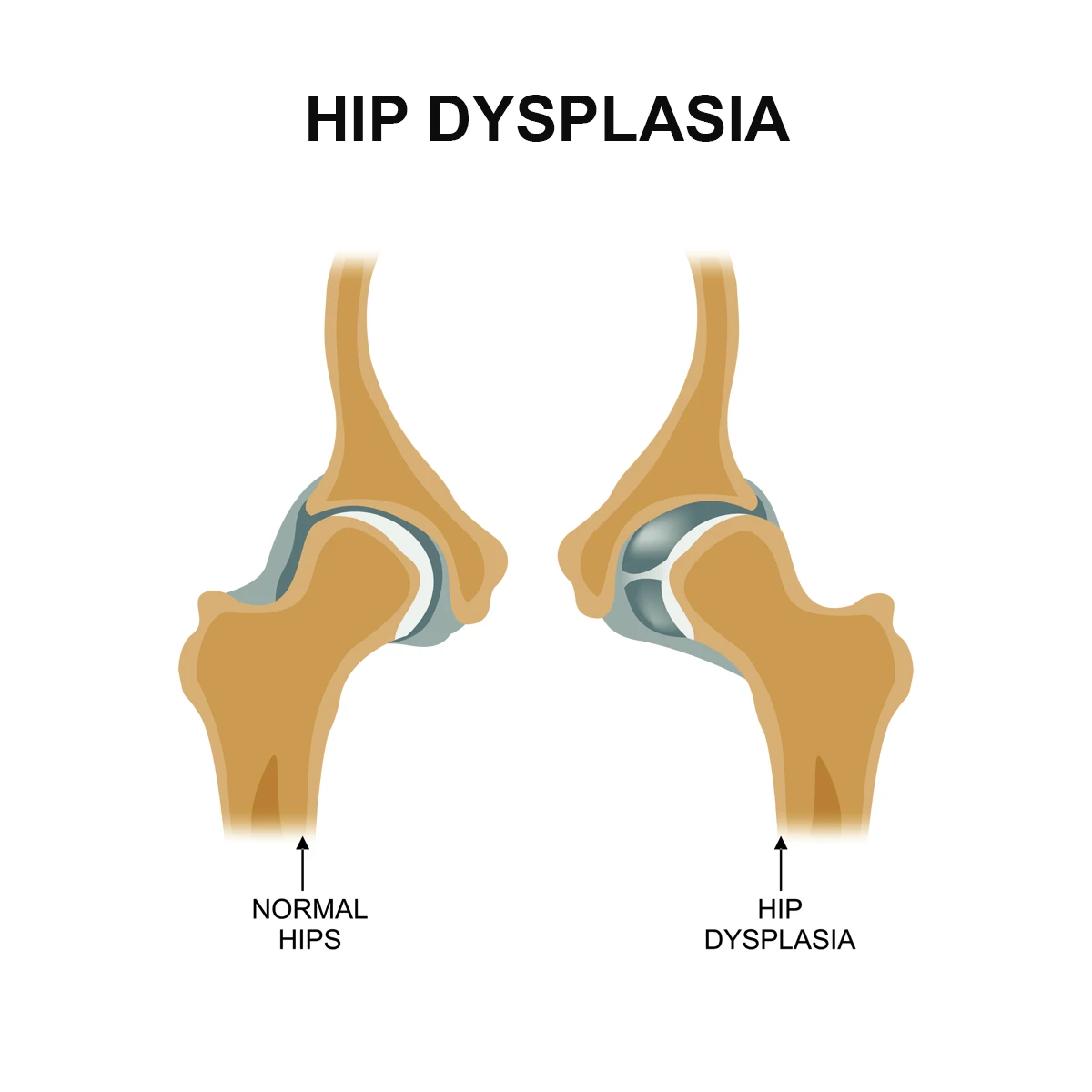 The image shows the difference between a normal hip and the hip in someone with hip dysplasia.