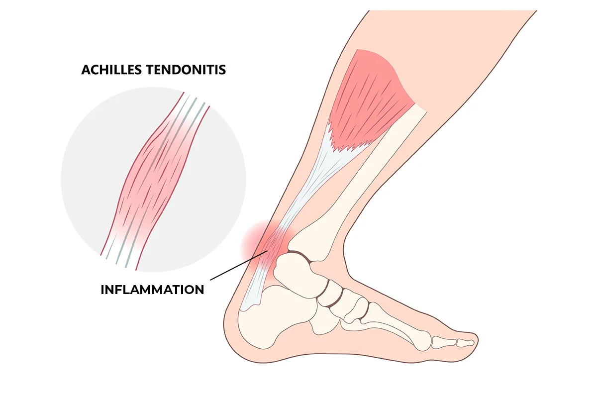 Image shows the Achilles tendon attaching to the calf muscle and the heel bone. Also shown is a common point of inflammation at about the level of the ankle.