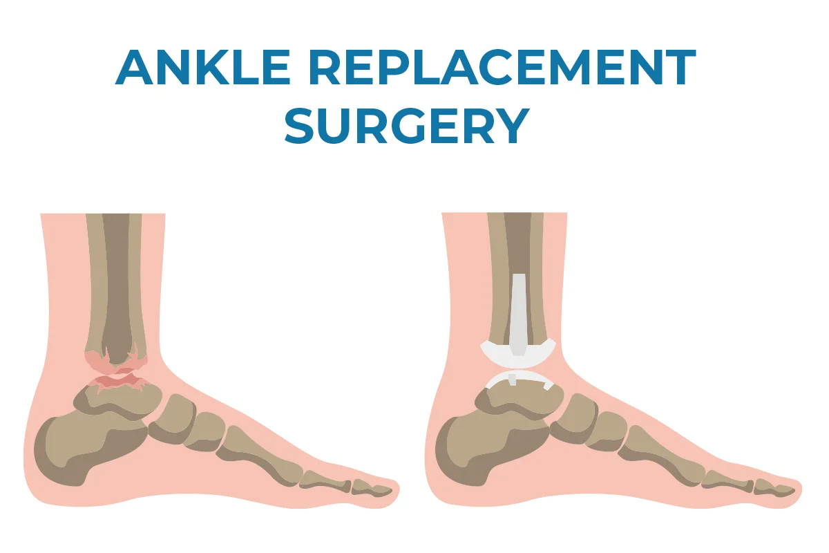 Image shows a damaged ankle joint compared to an ankle that has undergone ankle replacement surgery with joint prosthetics.