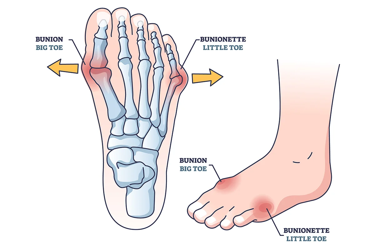 Image shows how bunions (hallux valgus) are formed when the joint at the base of the big toe bends sideways.