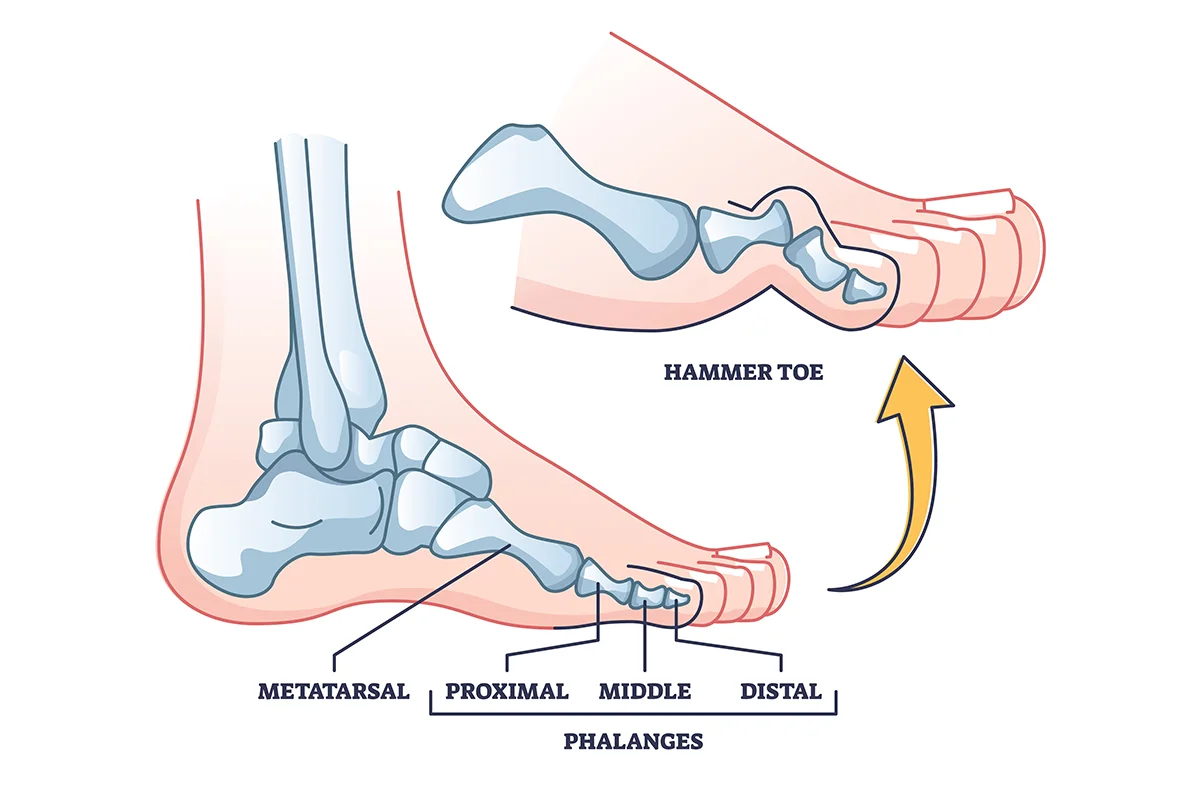 Image compares a normal toe with a straight joint to a hammer toe with a bent middle joint.