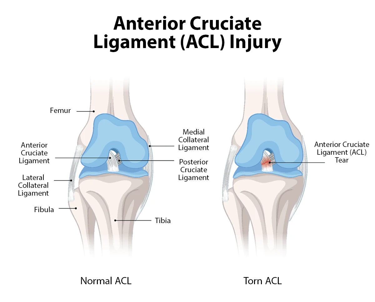 The image shows the difference between a knee with a healthy anterior cruciate ligament (ACL) and a knee with a torn ACL.