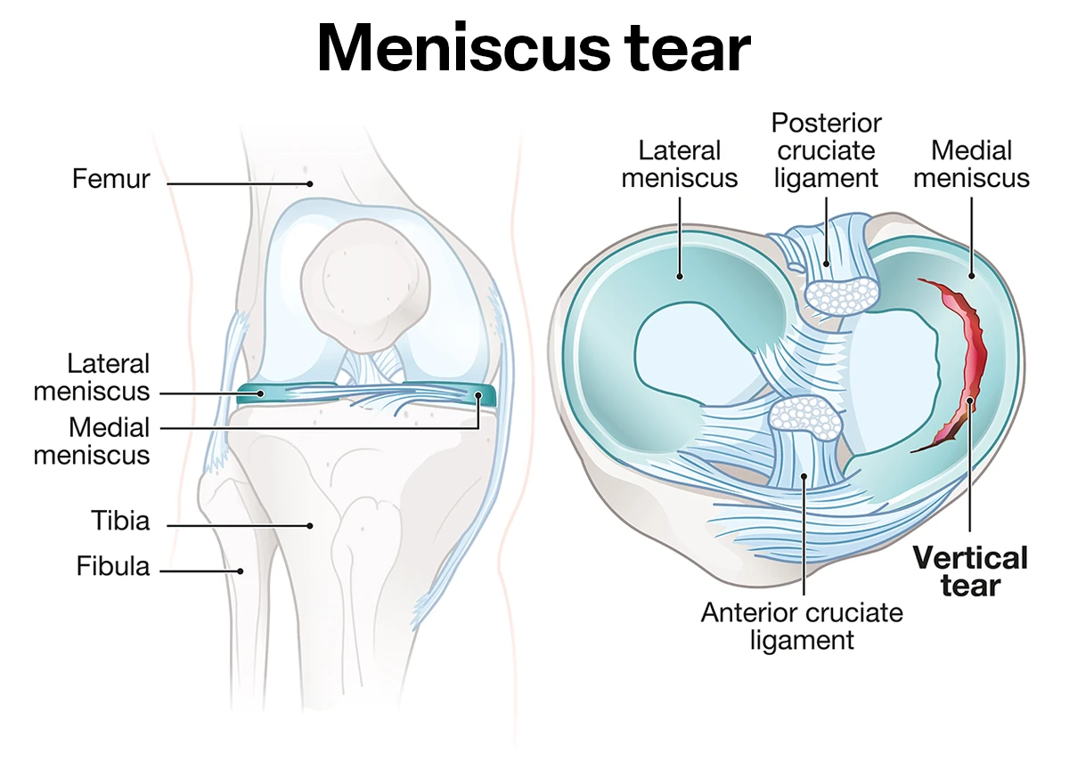 The image shows a tear in the medial meniscus cartilage in the knee.