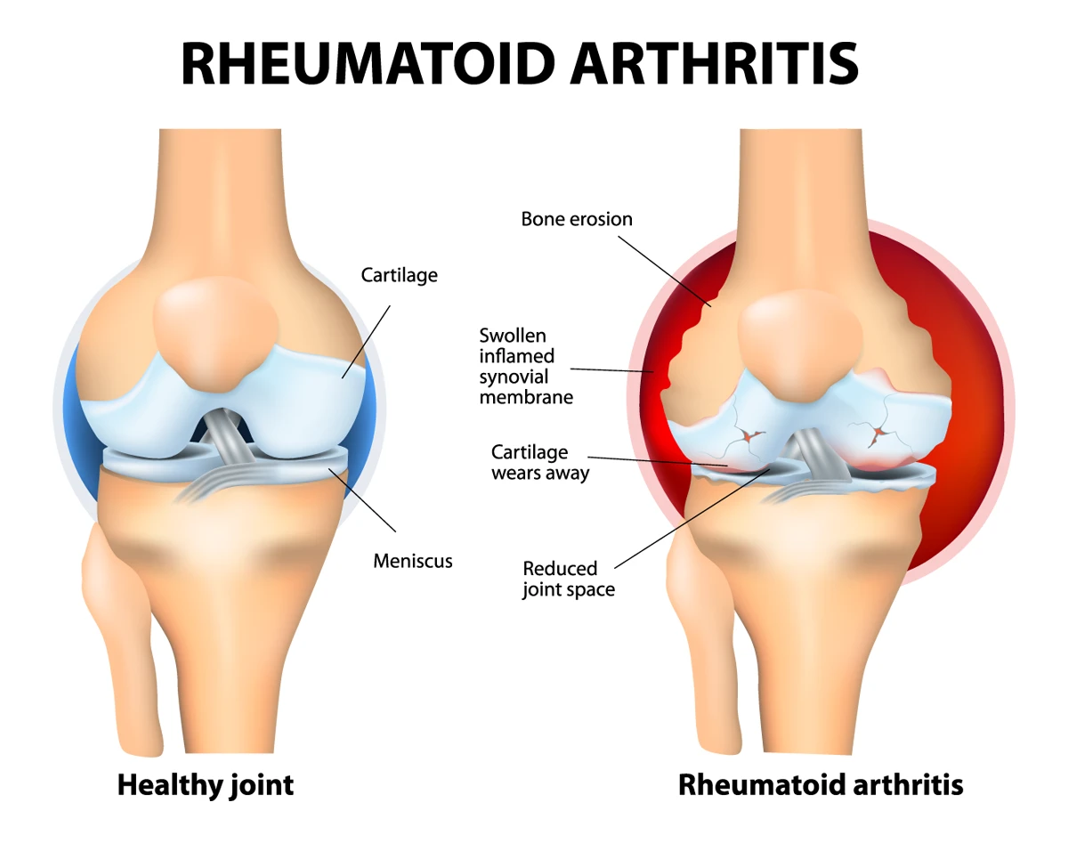 The image shows a healthy joint on the left and one affected by rheumatoid arthritis on the right.