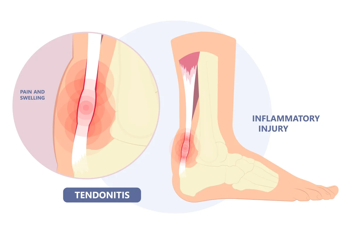 Image shows two images of inflammation of a tendon. One image is magnified to show just the tendon and the other shows the tendon’s location in the lower leg.