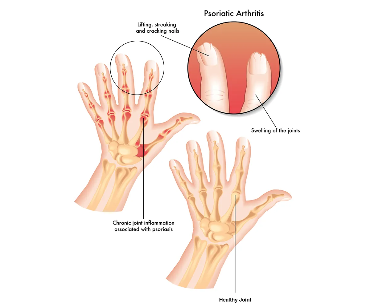 Images of common psoriatic arthritis symptoms – brittle, cracking fingernails and inflammation and swelling in joints.