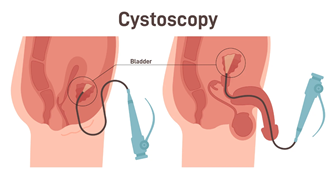Cystoscopy Cystoscopy