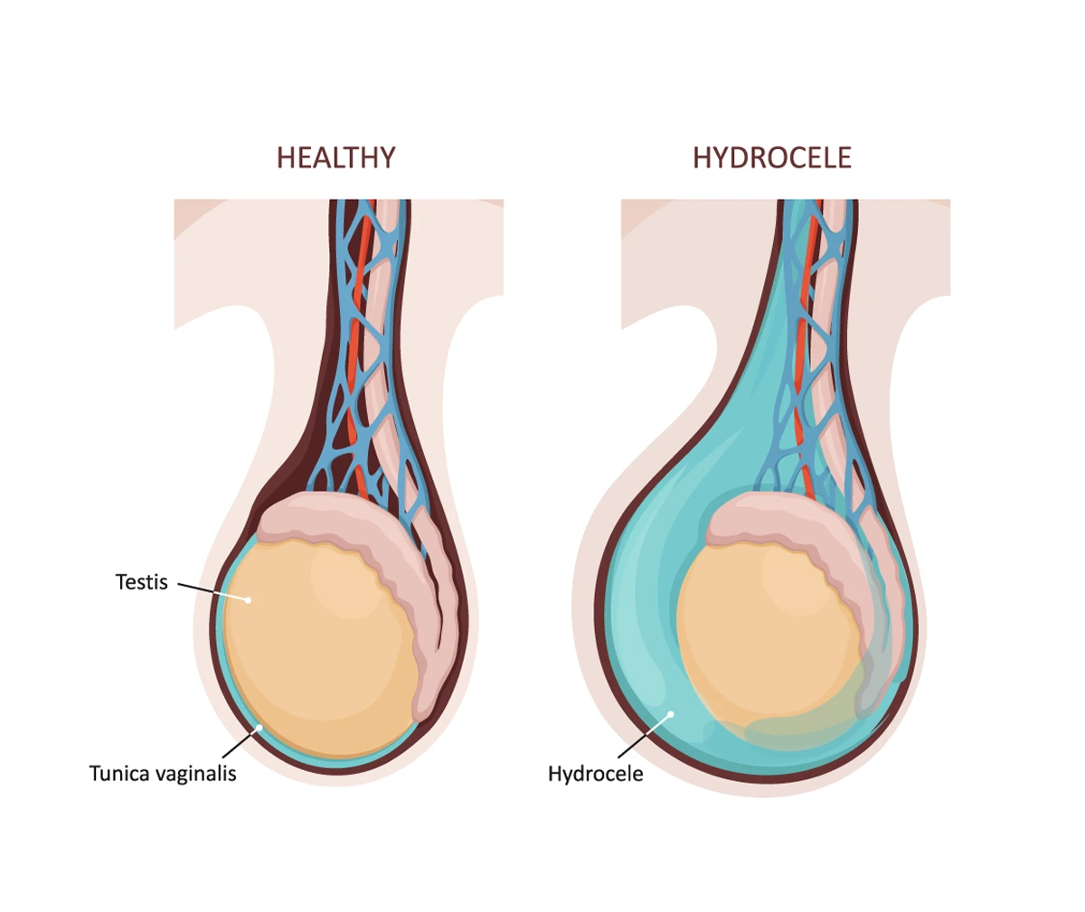 hydrocele