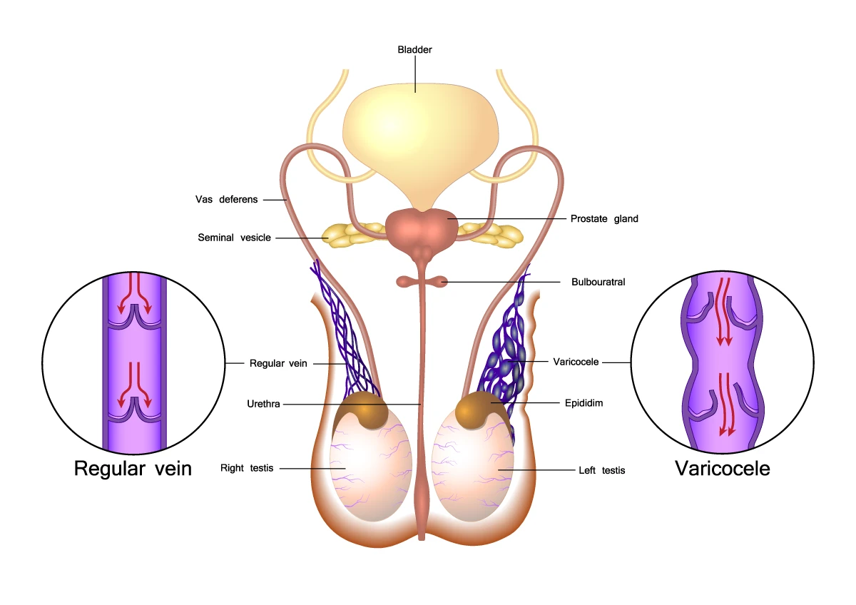 Veins that supply blood from the testicles are affected by varicoceles, left, compared to healthy veins as seen on the right.