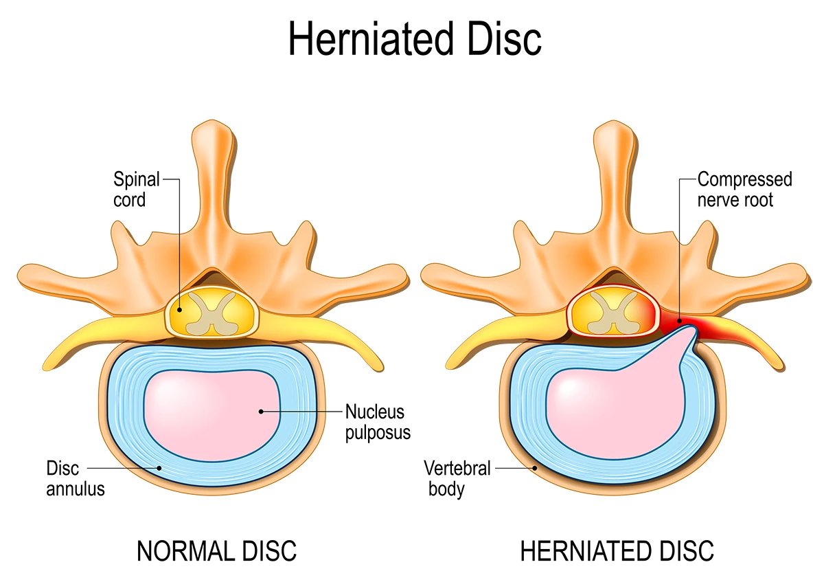 In a herniated disc, inflammation causes the pulp inside the disc of the vertebra to protrude and compress the nerve in the spinal cord.