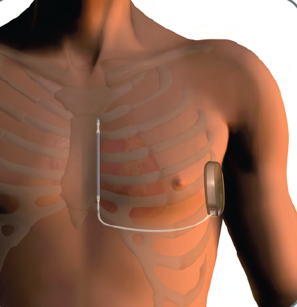 A skin-deep device delivers a life-saving shock to the heart without the need for a pacemaker.
