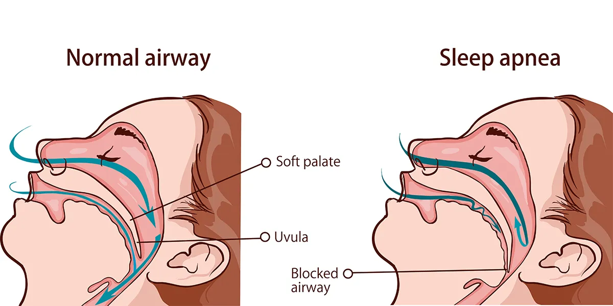 Illustration compares a normal airway with an airway affected by sleep apnea. The image shows how the soft palate and uvula block the airway in sleep apnea, leading to breathing difficulties.